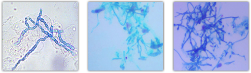 jock itch quick cure